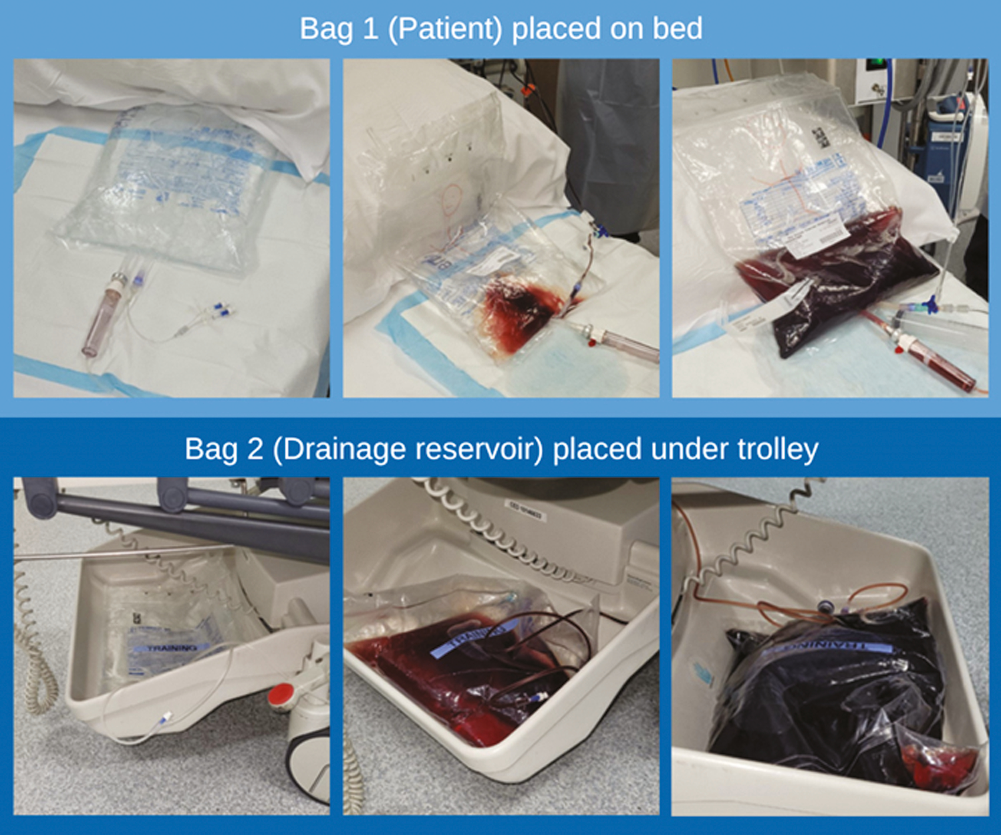 ‘Patient’ and drainage reservoir over course of scenario