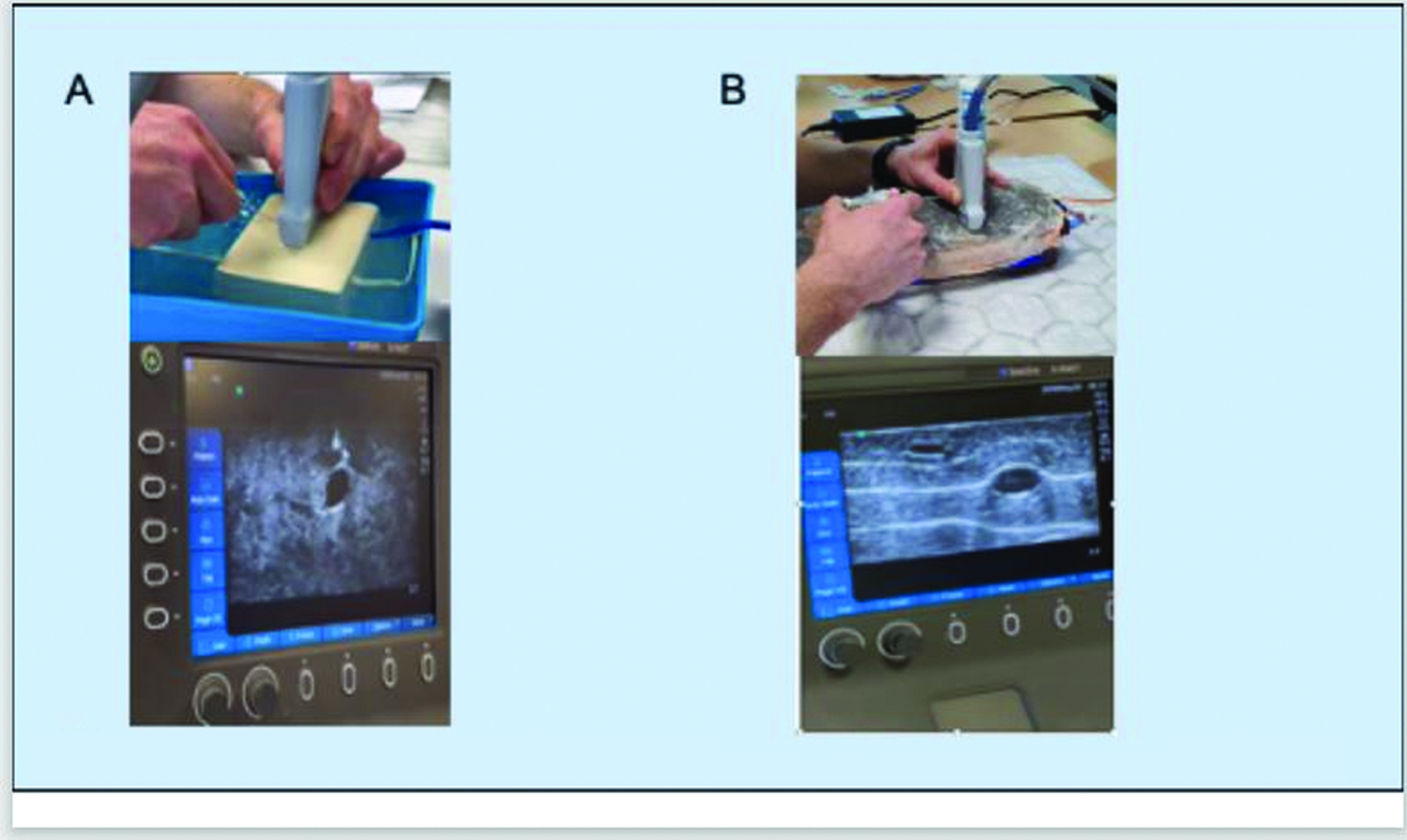 Models used to deliver teaching sessions. After ADAMgel became available this has been used exclusively due to it being more reusable compared to the tofu modelsA: tofu model with ultrasound image underneath.B: ADAMgel model with ultrasound image underneath